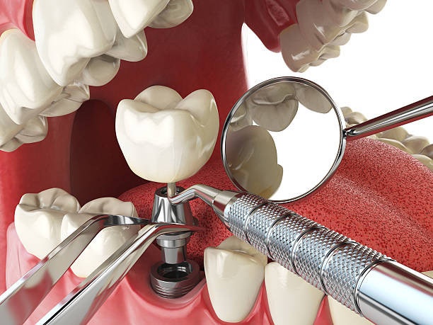 Best Emergency Treatment for Dental Infections or Abscesses in Trenton, MI